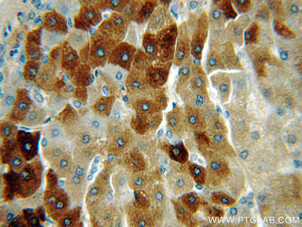 IHC staining of human hepatocirrhosis using 19807-1-AP