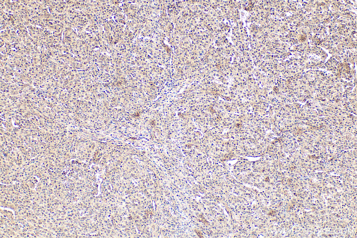 IHC staining of human lymphoma using 12133-2-AP