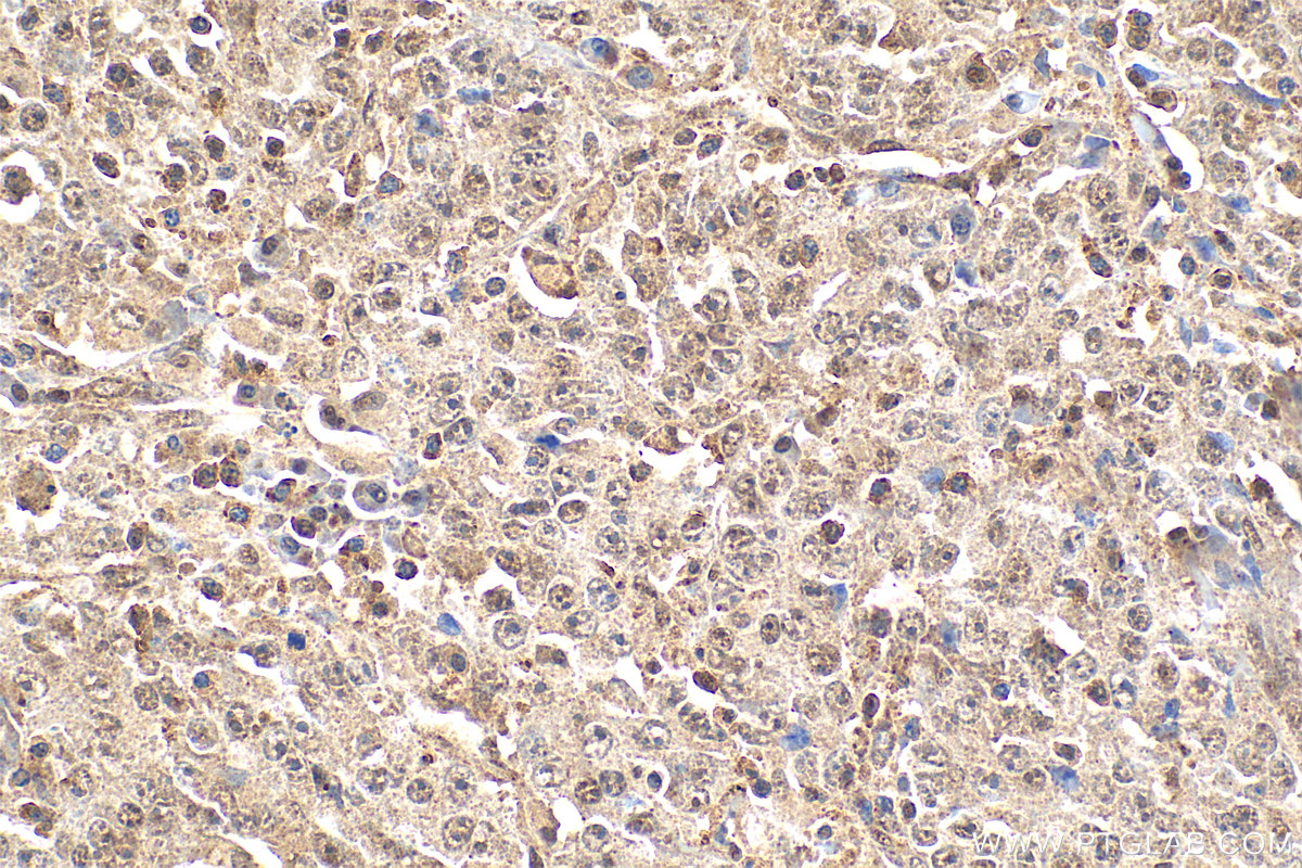IHC staining of human lymphoma using 12133-2-AP