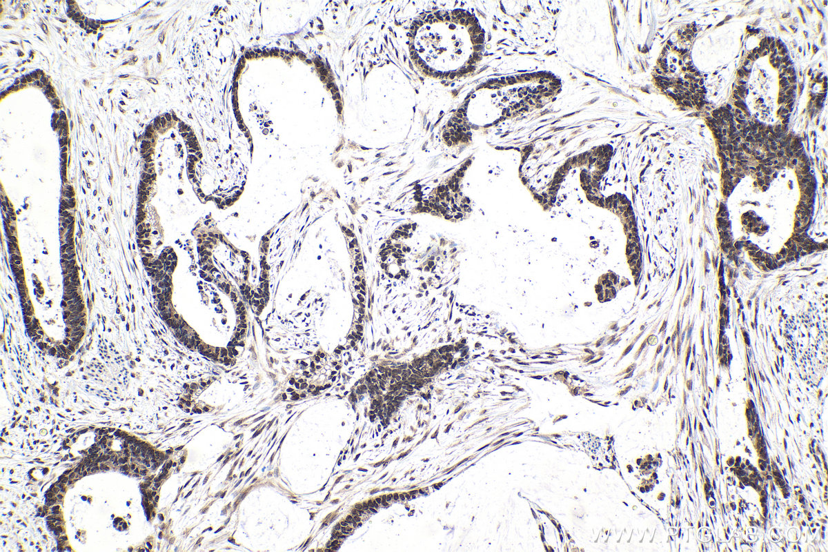 IHC staining of human urothelial carcinoma using 68486-1-Ig (same clone as 68486-1-PBS)