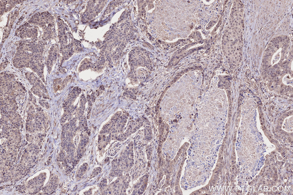 IHC staining of human stomach cancer using 26870-1-AP