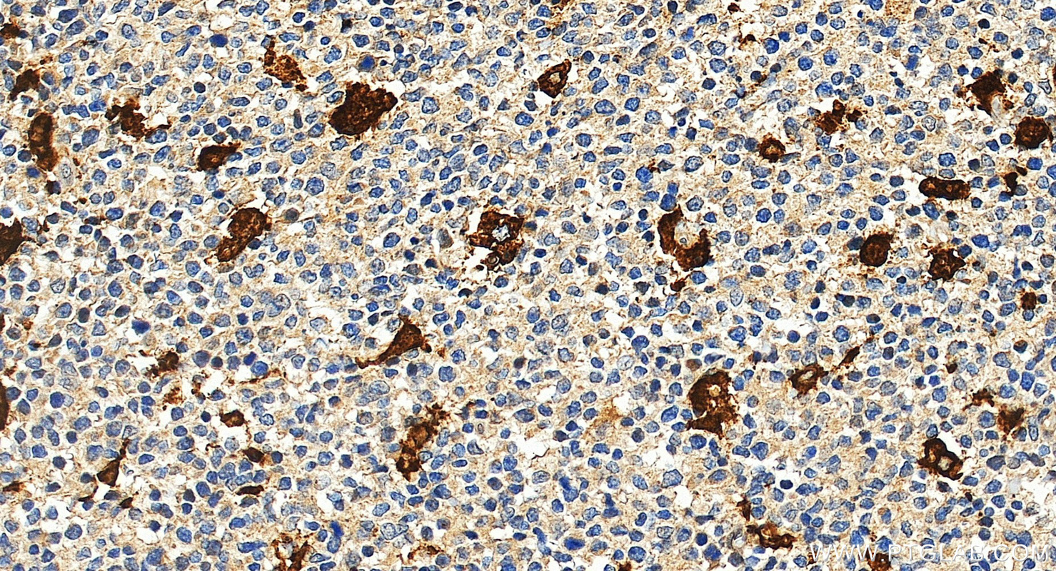 IHC staining of human tonsillitis using 12008-1-AP (same clone as 12008-1-PBS)
