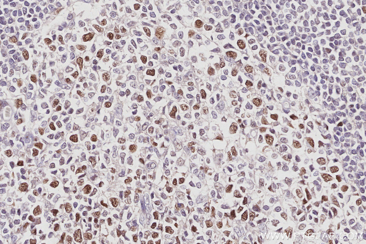 IHC staining of human appendicitis using 14421-1-AP IHC staining of human appendicitis using 14421-1-AP