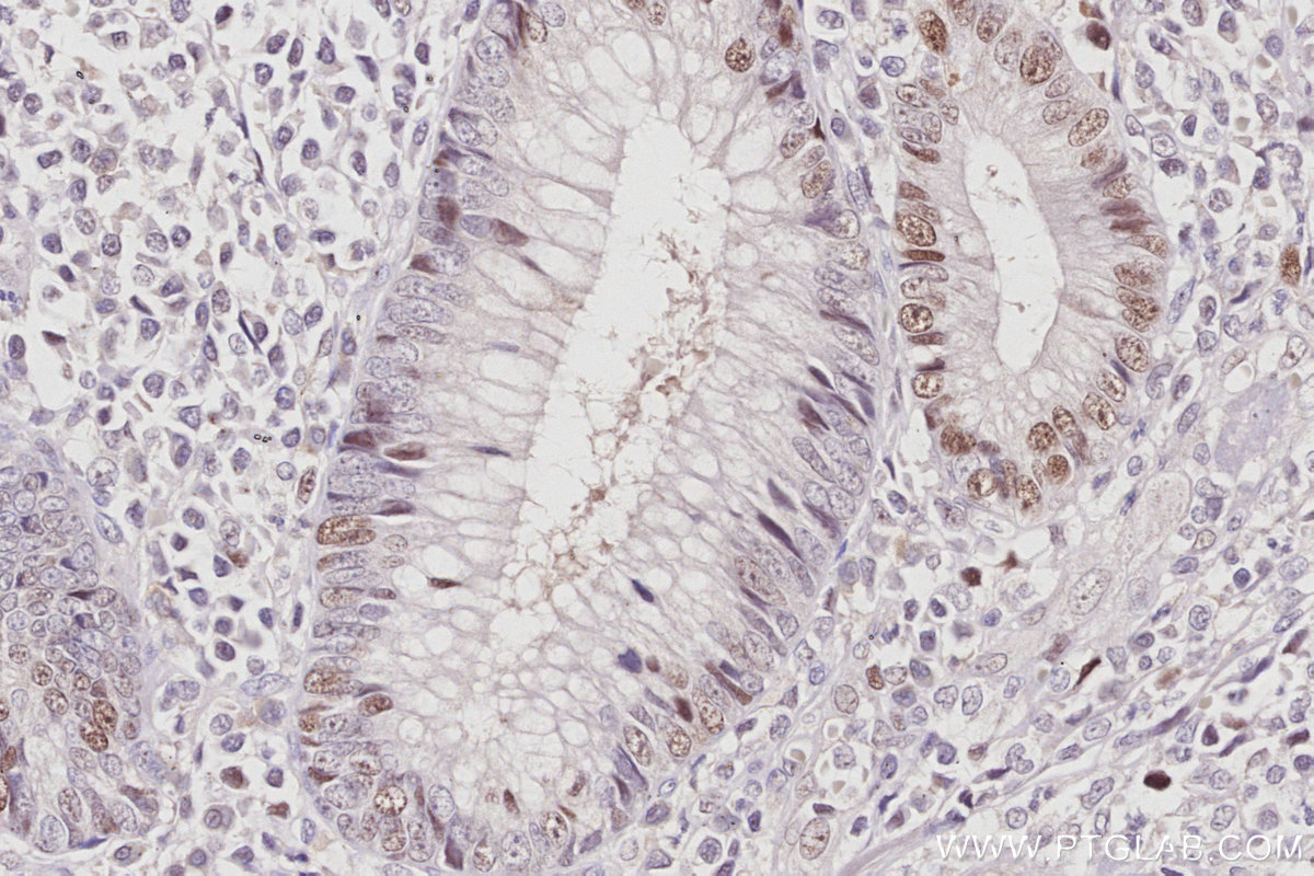 IHC staining of human appendicitis using 14421-1-AP IHC staining of human appendicitis using 14421-1-AP