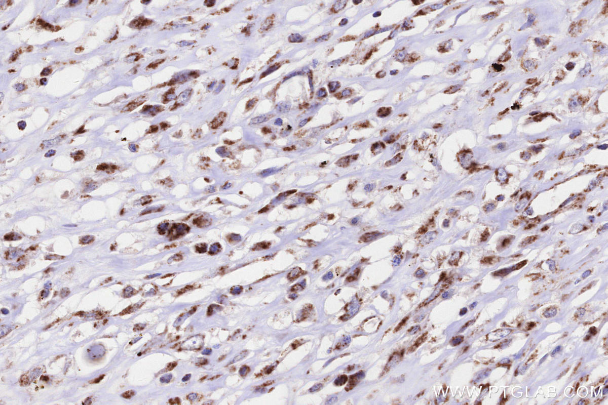IHC staining of human colon cancer using 11124-2-AP