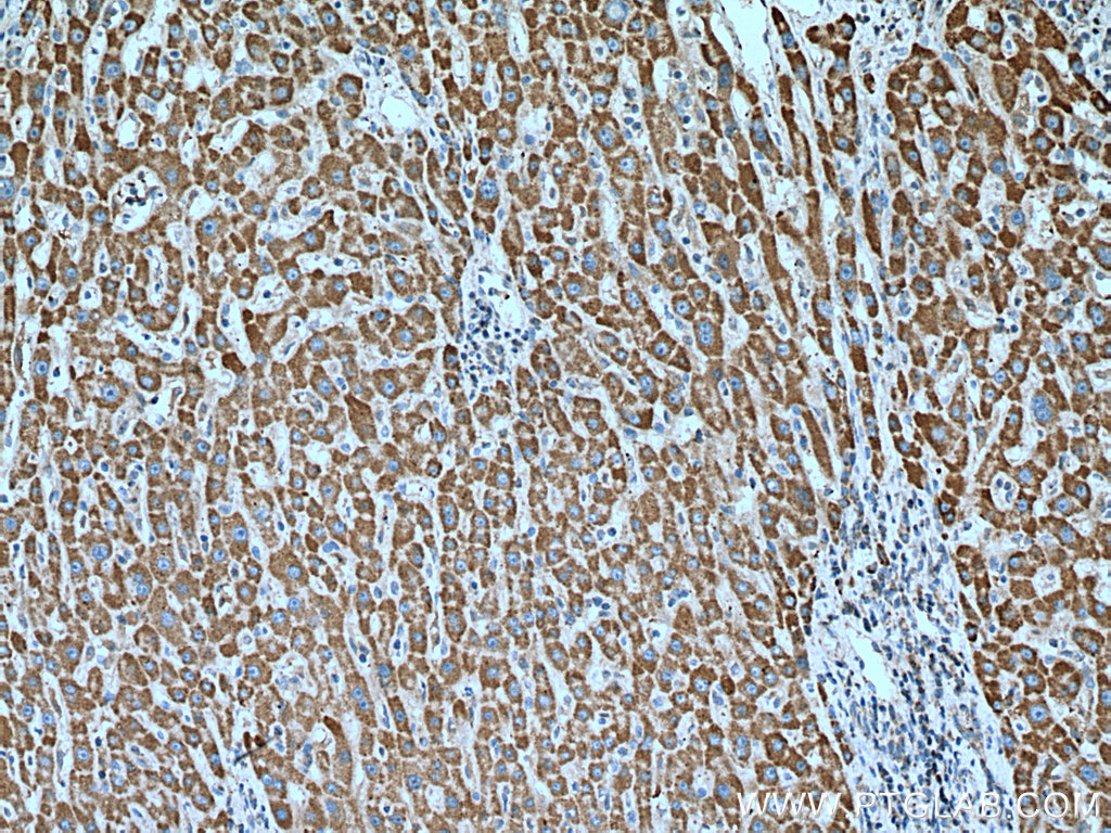 IHC staining of human liver cancer using 11973-1-AP
