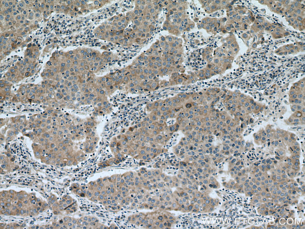 IHC staining of human breast cancer using 11189-1-AP