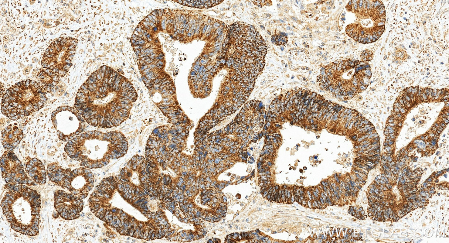 IHC staining of human colon cancer using 11062-1-AP