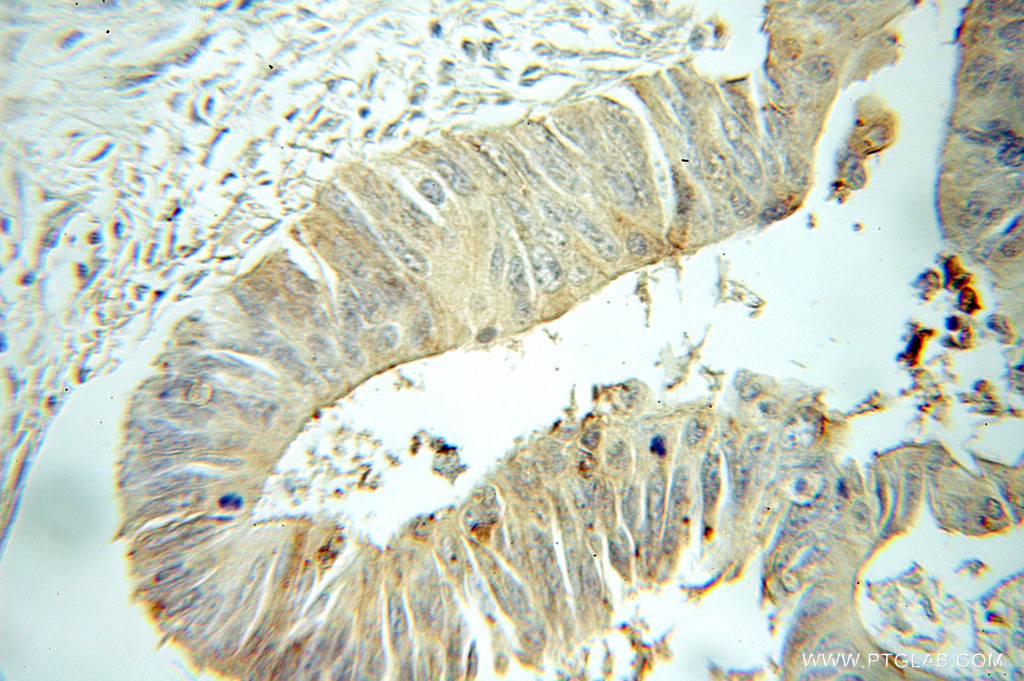 IHC staining of human colon cancer using 11062-1-AP