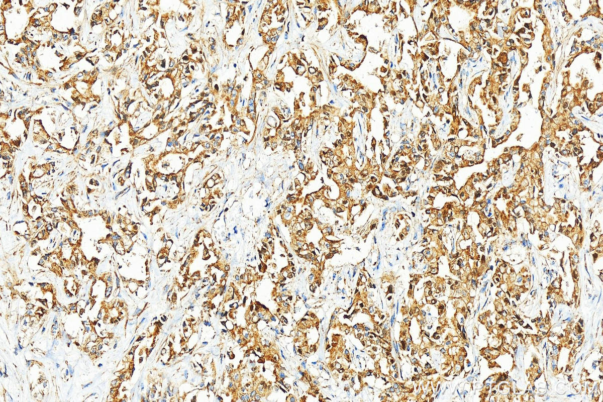 IHC staining of human intrahepatic cholangiocarcinoma using 11179-1-AP