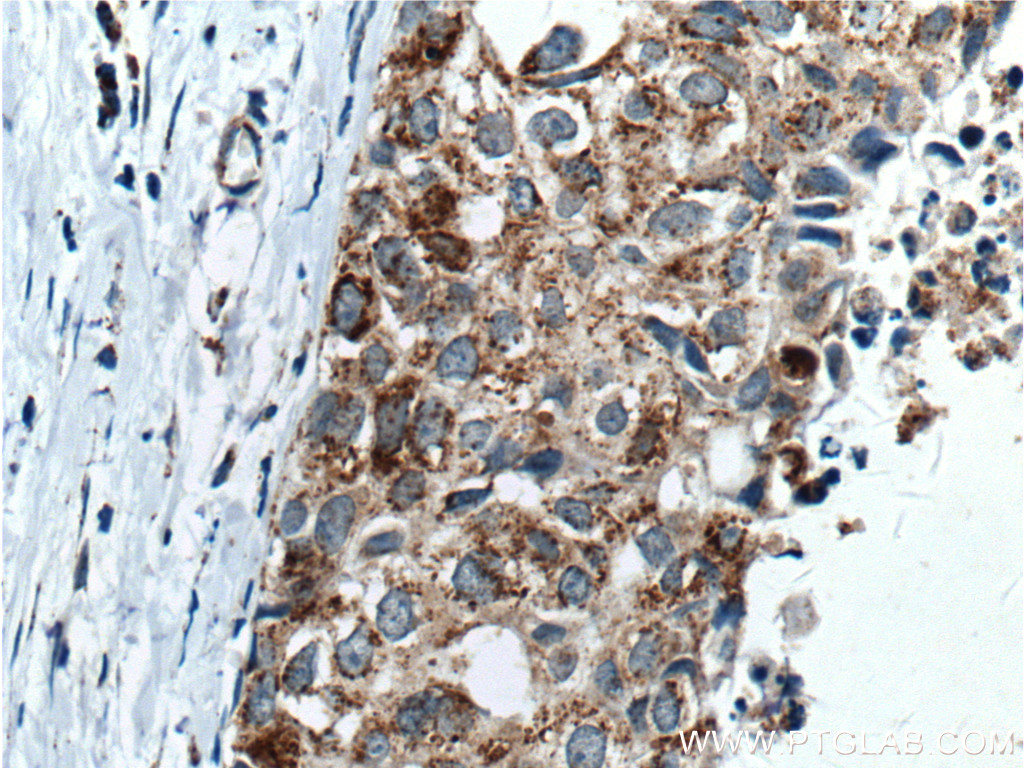IHC staining of human breast cancer using 10753-1-AP