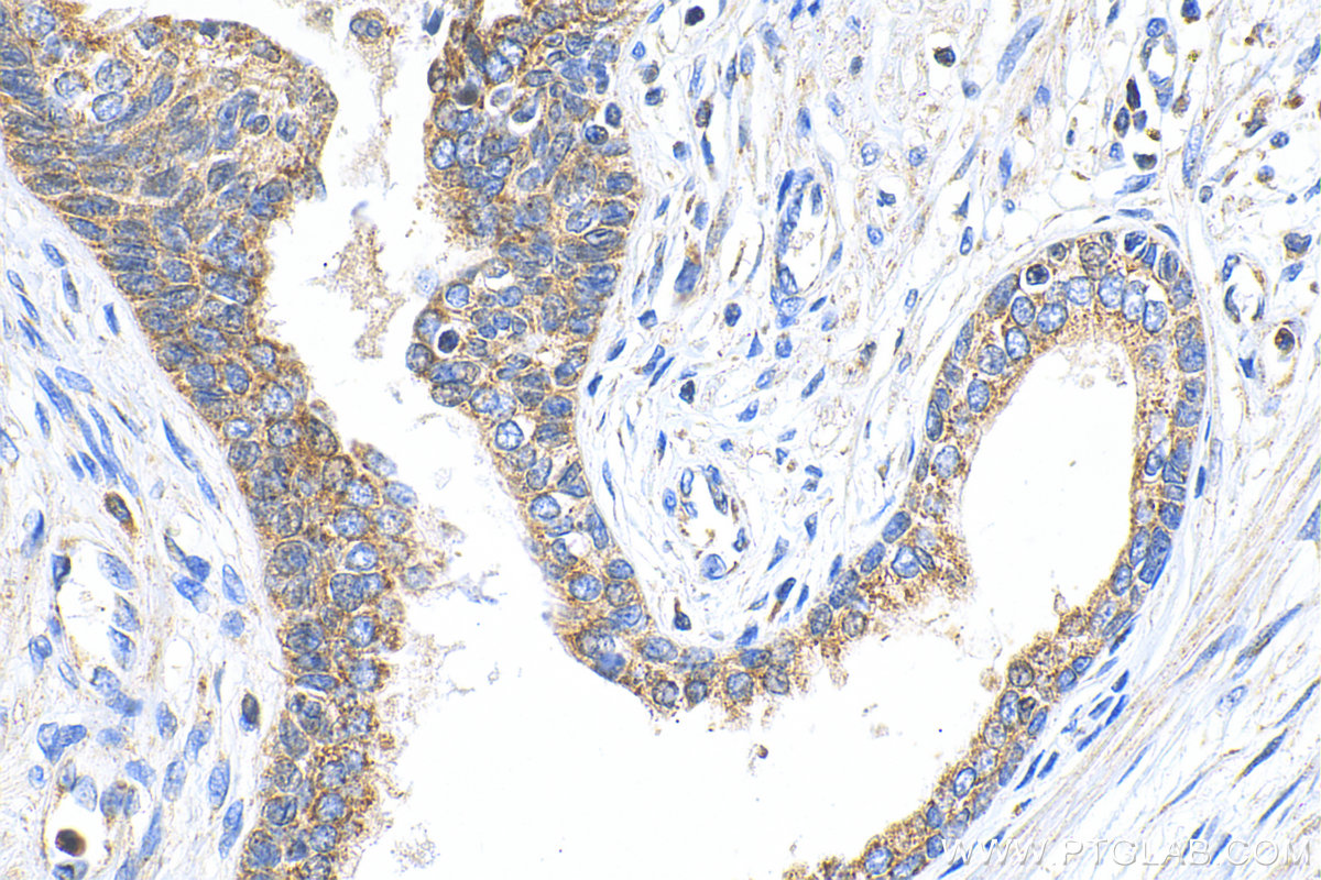 IHC staining of human prostate cancer using 17353-1-AP