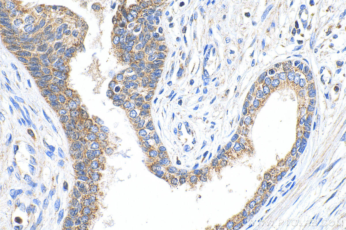 IHC staining of human prostate cancer using 17353-1-AP