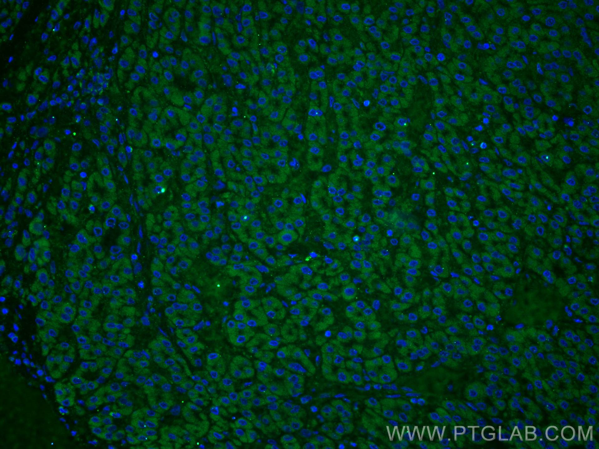 IF Staining of human liver cancer using 12077-1-AP