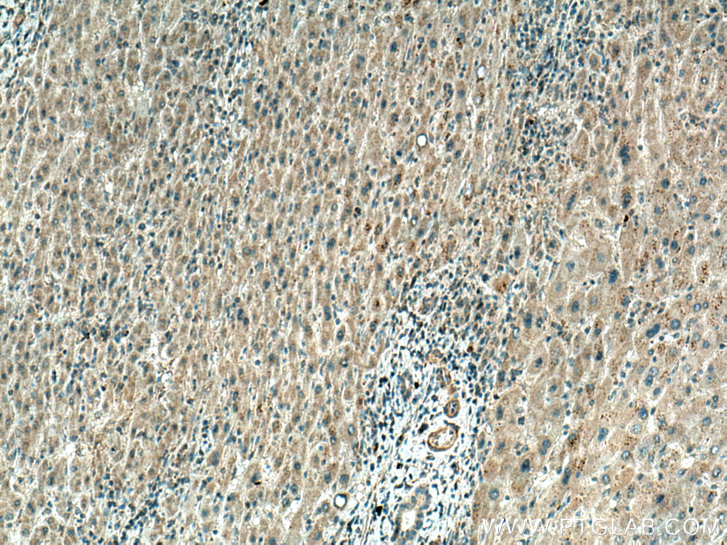 IHC staining of human liver cancer using 12077-1-AP