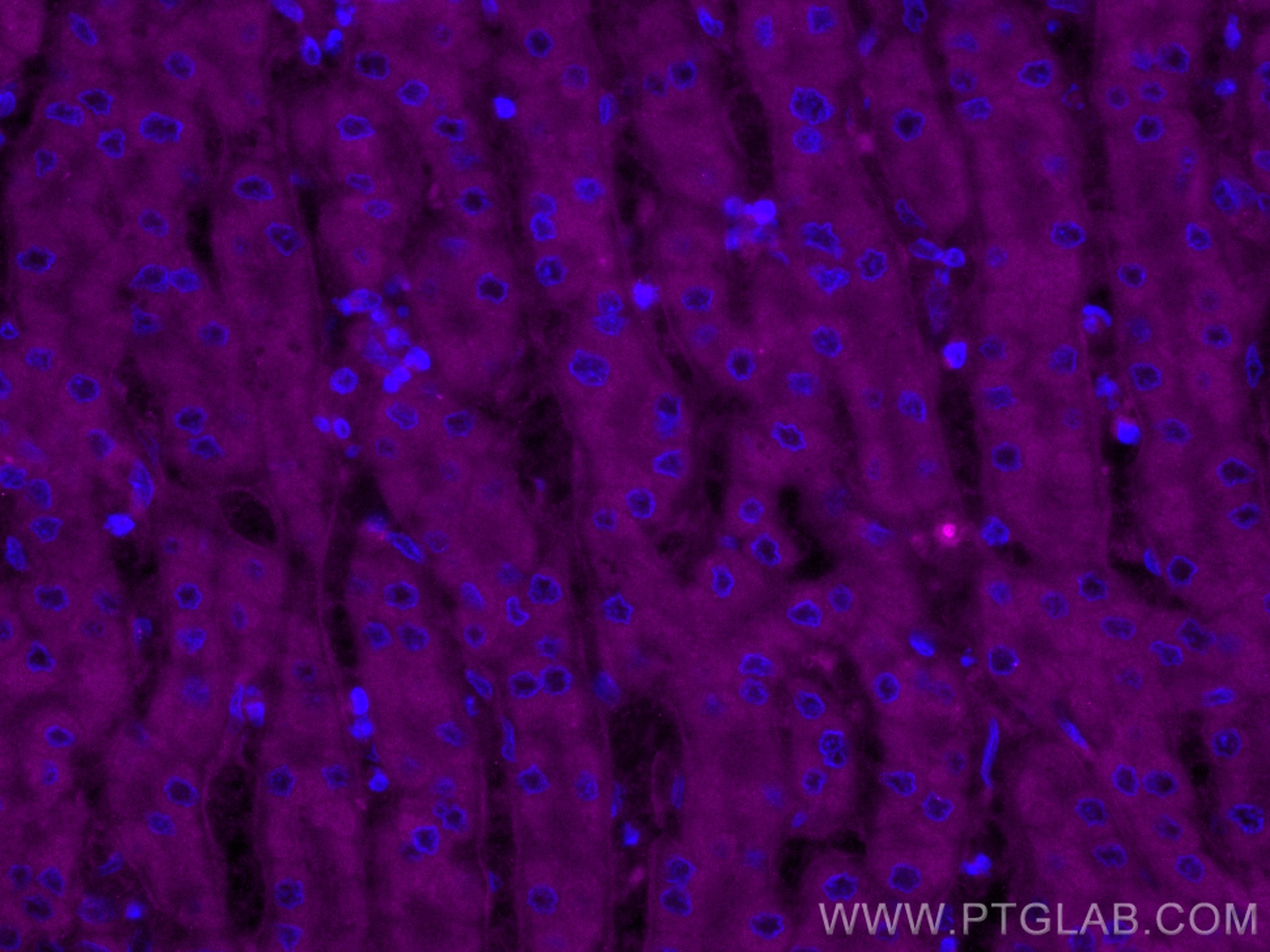 IF Staining of human liver cancer using CL647-12077