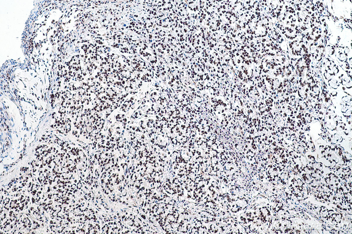 IHC staining of human colon cancer using 66016-1-Ig (same clone as 66016-1-PBS)
