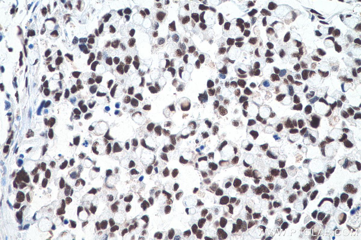 IHC staining of human colon cancer using 66016-1-Ig (same clone as 66016-1-PBS)