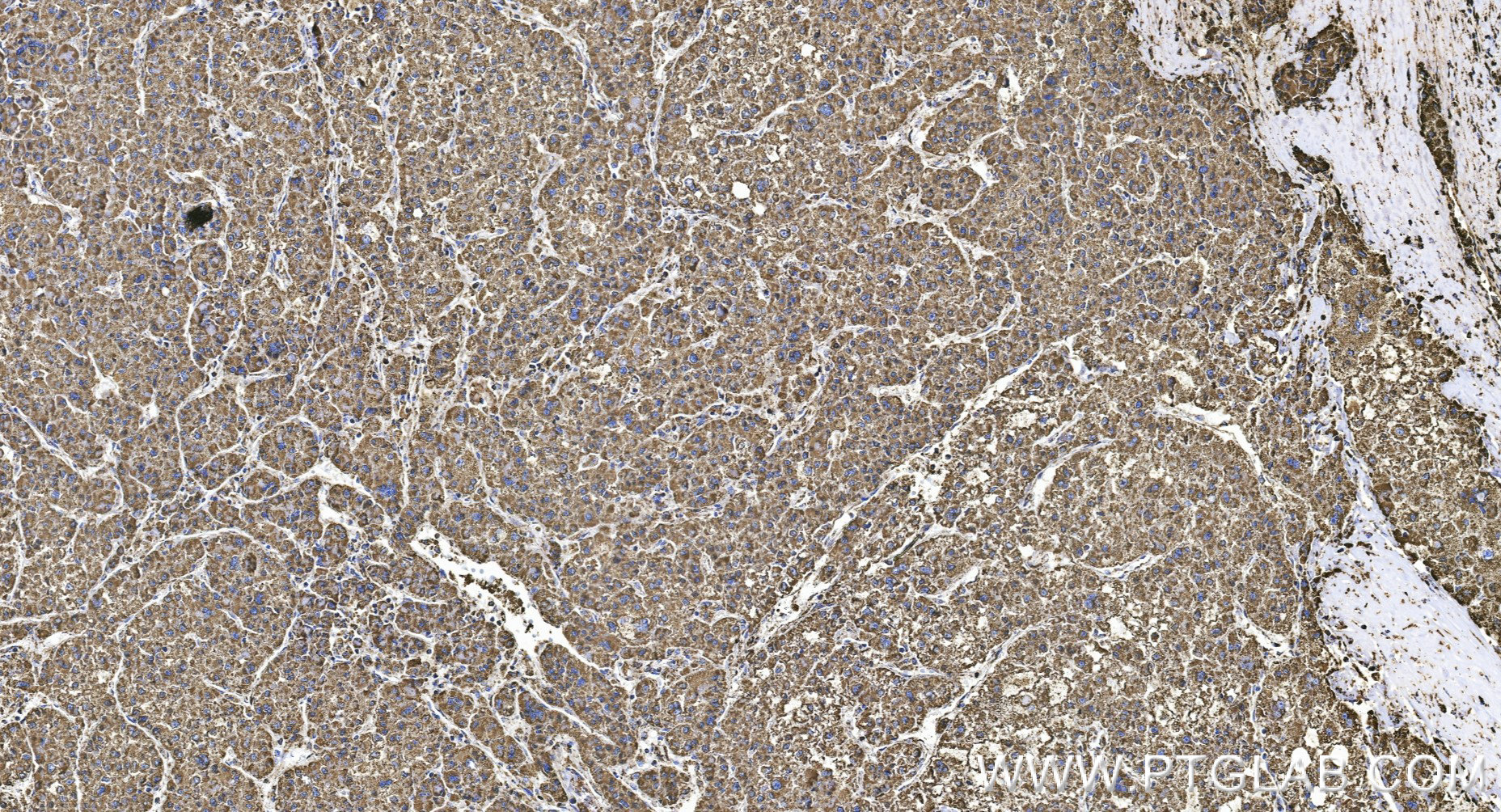 IHC staining of human liver cancer using 85877-1-RR