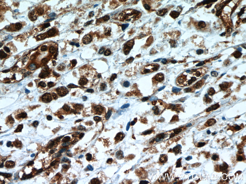 IHC staining of human breast cancer using 66083-1-Ig (same clone as 66083-1-PBS)