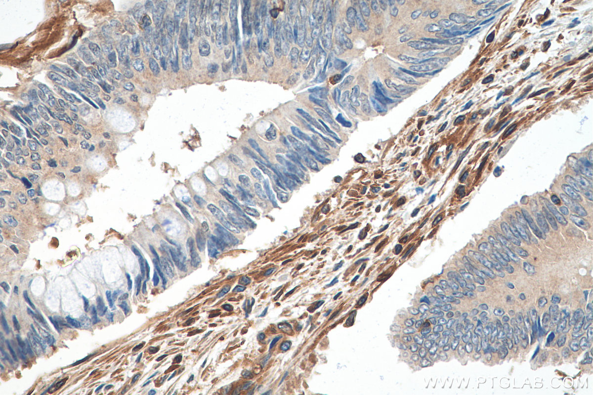 IHC staining of human colon cancer using 67992-1-Ig (same clone as 67992-1-PBS)