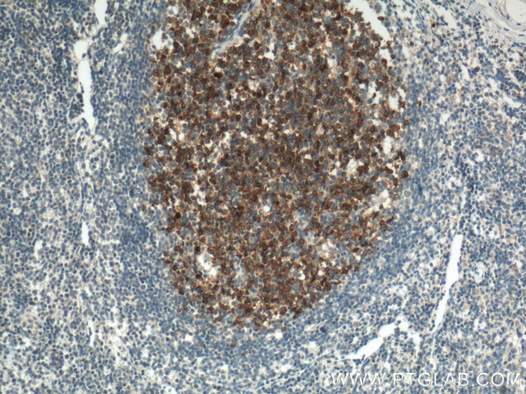 IHC staining of human tonsillitis using 66350-1-Ig (same clone as 66350-1-PBS)
