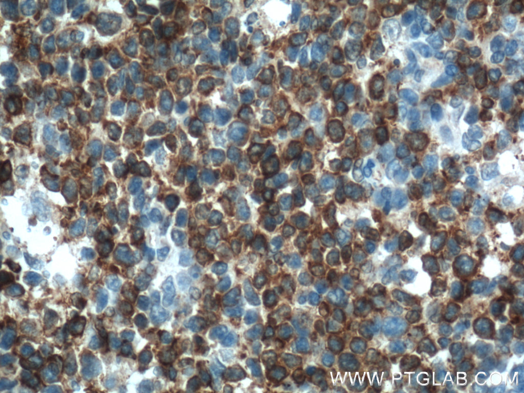 IHC staining of human tonsillitis using 66350-1-Ig (same clone as 66350-1-PBS)