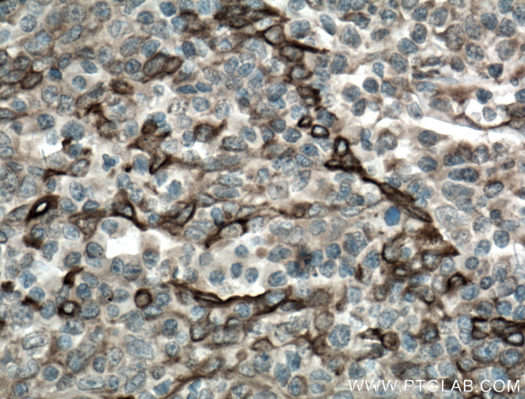 IHC staining of human tonsillitis using 67317-1-Ig