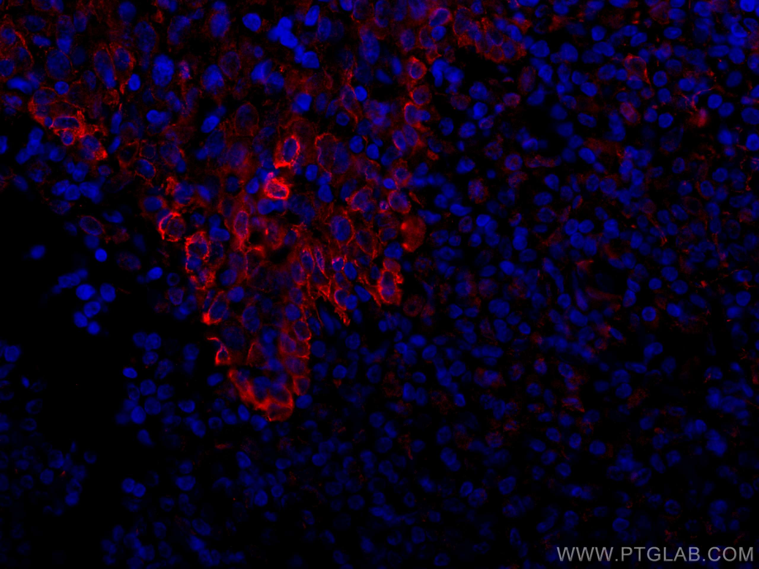 IF Staining of human tonsillitis using CL594-67317