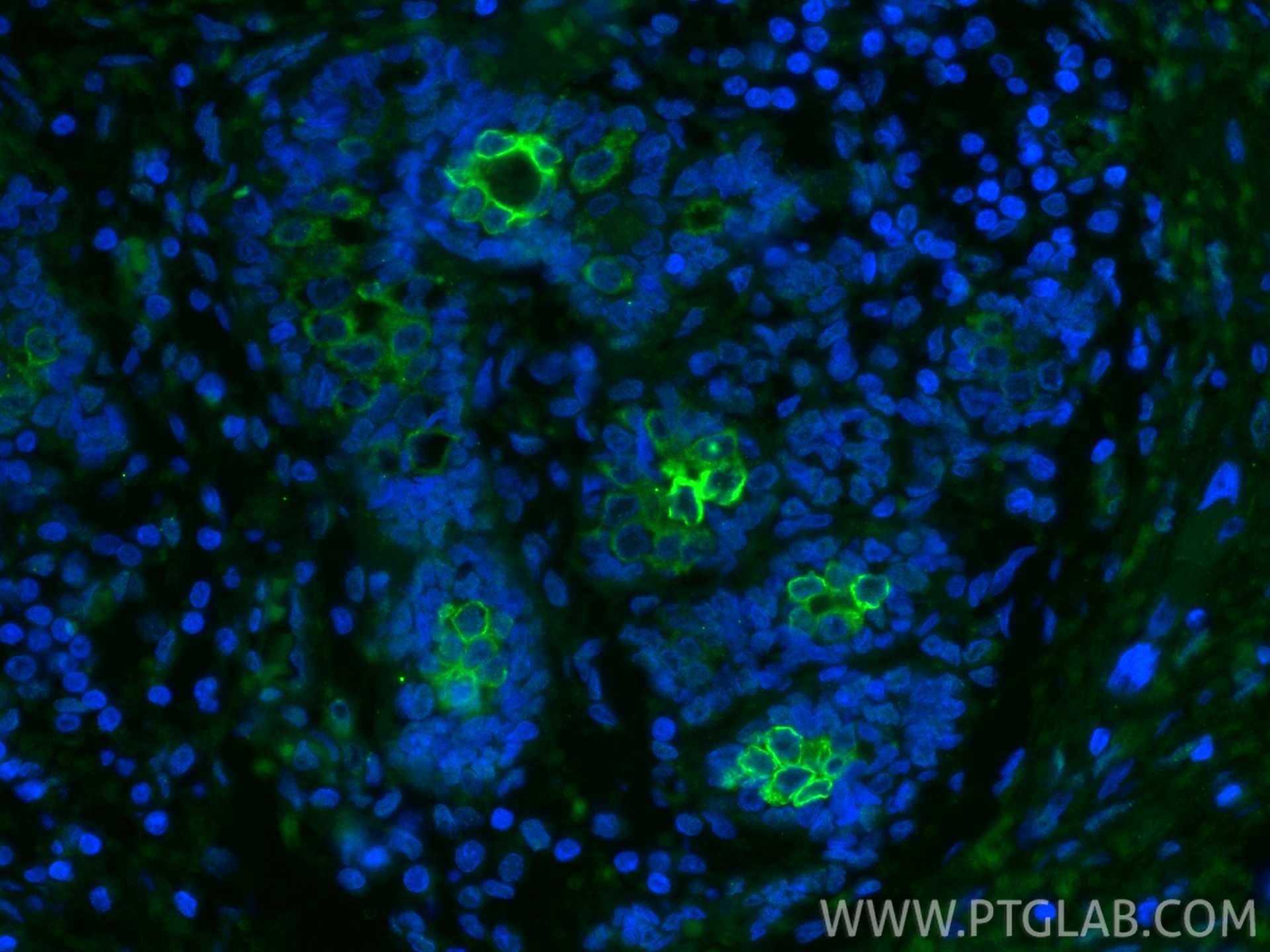 Immunofluorescent analysis of (4% PFA) fixed paraffin-embedded human breast cancer tissue using FITC Plus TLR8 antibody (FITC-67317, Clone: 3B6A4 ) at dilution of 1:200. Heat mediated antigen retrieval with Tris-EDTA buffer (pH 9.0). IF Staining of human breast cancer using FITC-67317