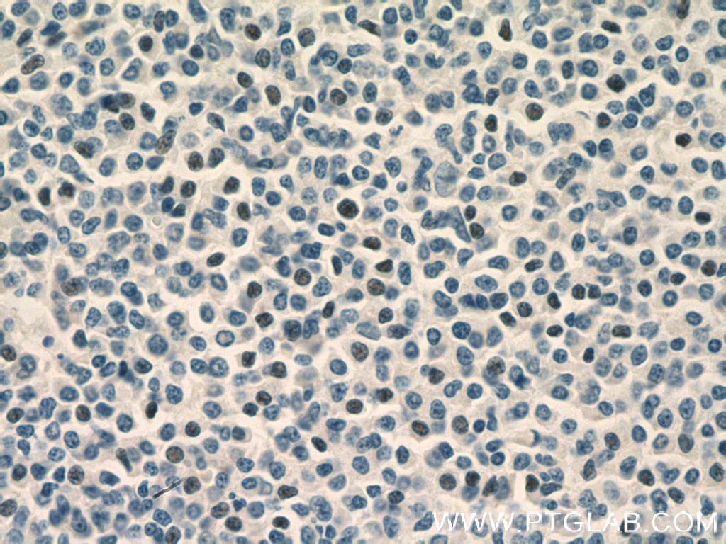 IHC staining of human lymphoma using 26877-1-AP