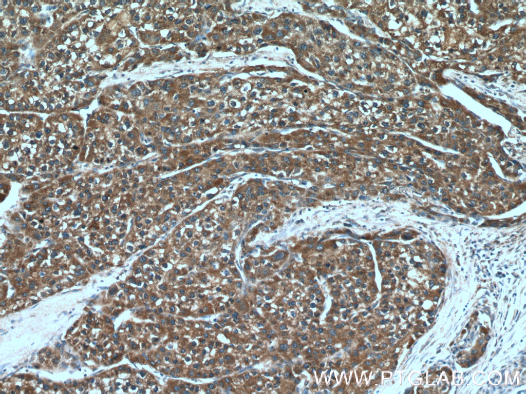 Immunohistochemical analysis of paraffin-embedded human liver cancer tissue slide using 18239-1-AP (TM4SF5 antibody) at dilution of 1:200 (under 10x lens). IHC staining of human liver cancer using 18239-1-AP