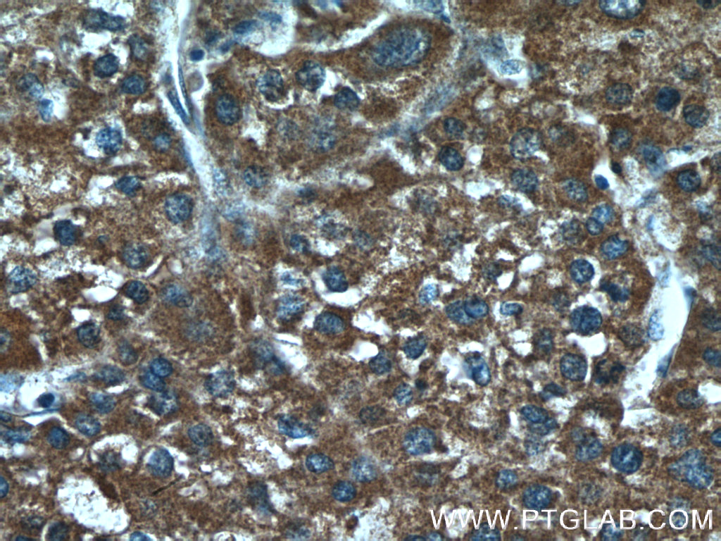 Immunohistochemical analysis of paraffin-embedded human liver cancer tissue slide using 18239-1-AP (TM4SF5 antibody) at dilution of 1:200 (under 40x lens). IHC staining of human liver cancer using 18239-1-AP