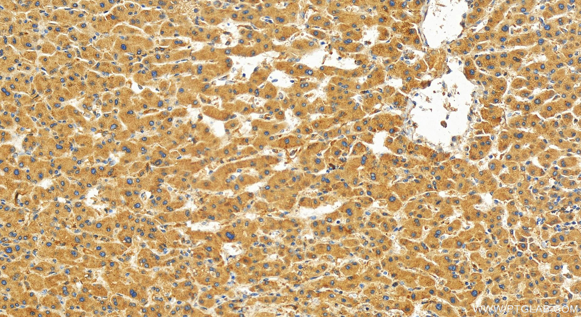 IHC staining of human intrahepatic cholangiocarcinoma using 27757-1-AP (same clone as 27757-1-PBS)