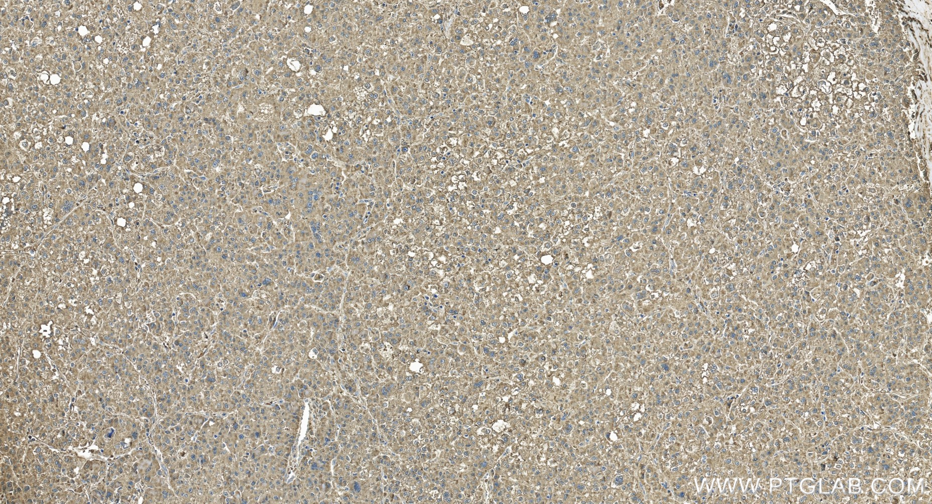 IHC staining of human liver cancer using 86440-1-RR