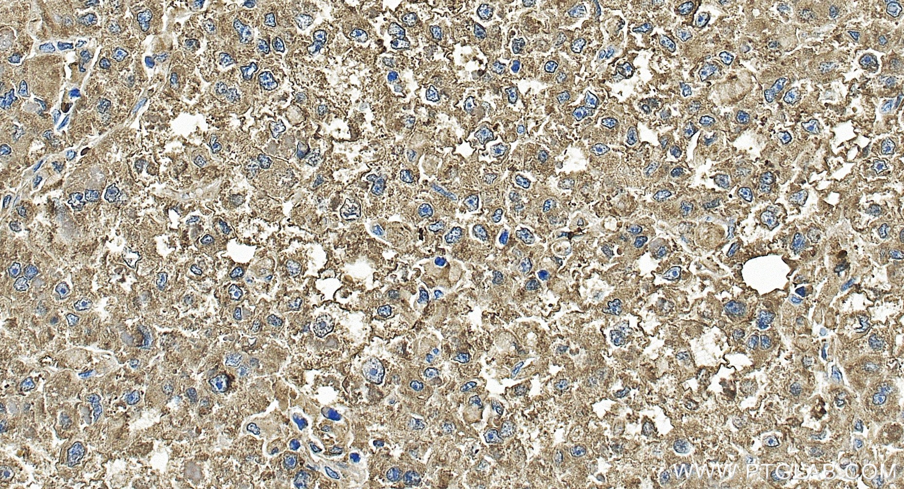 IHC staining of human liver cancer using 86440-1-RR