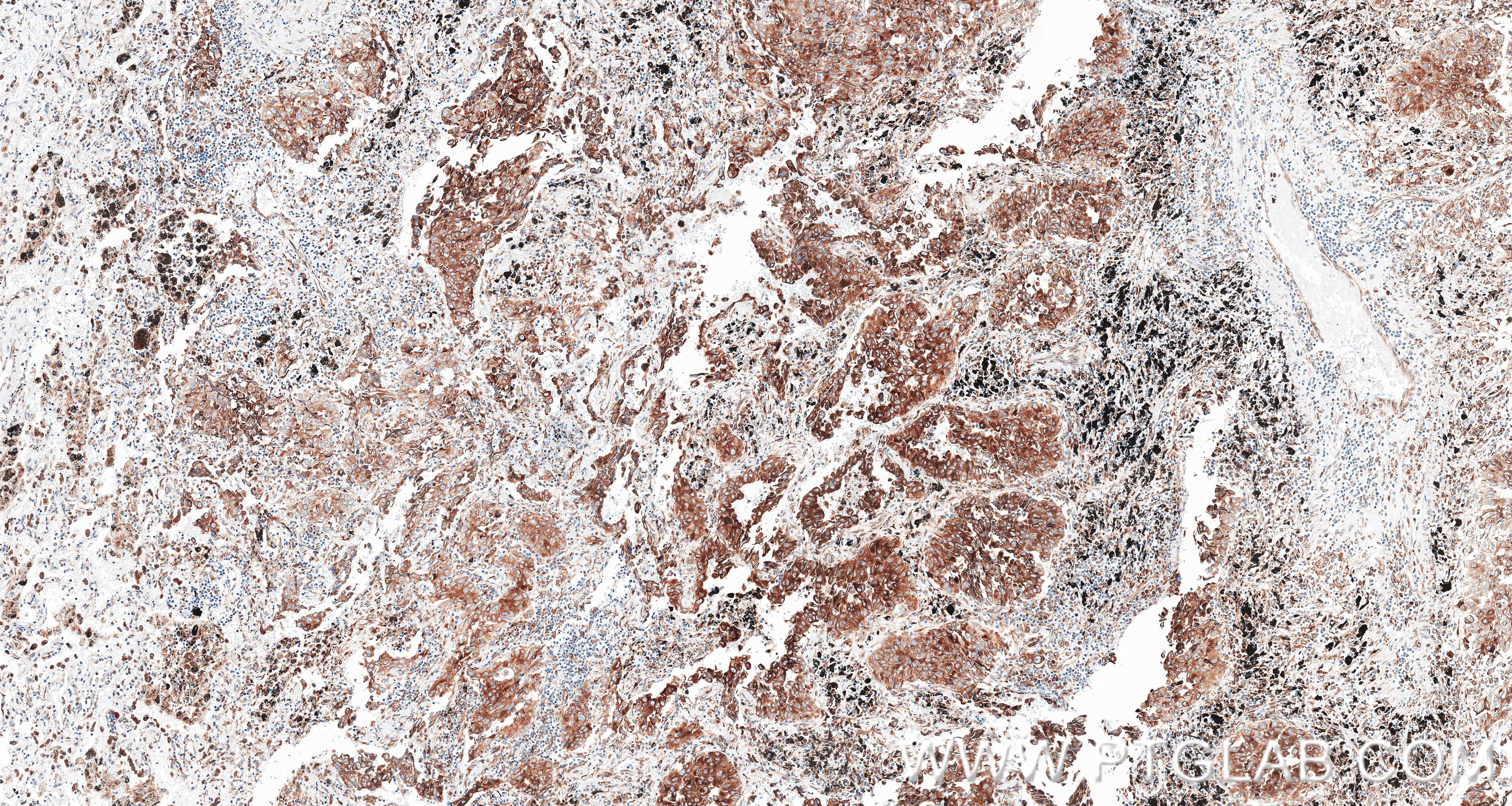 IHC staining of Human lung cancer （Adenocarcinoma） using 87837-1-RR