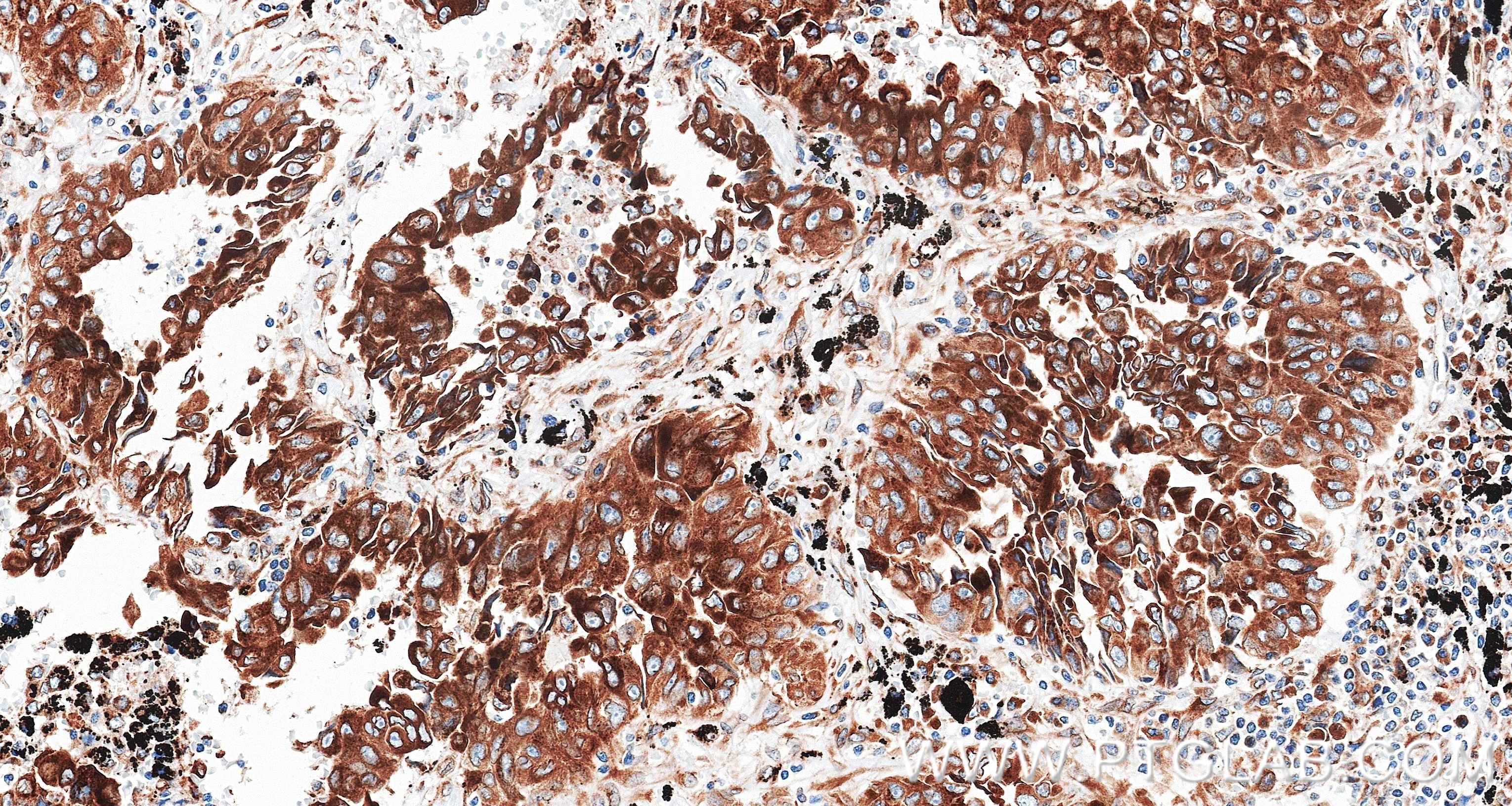 IHC staining of Human lung cancer （Adenocarcinoma） using 87837-1-RR