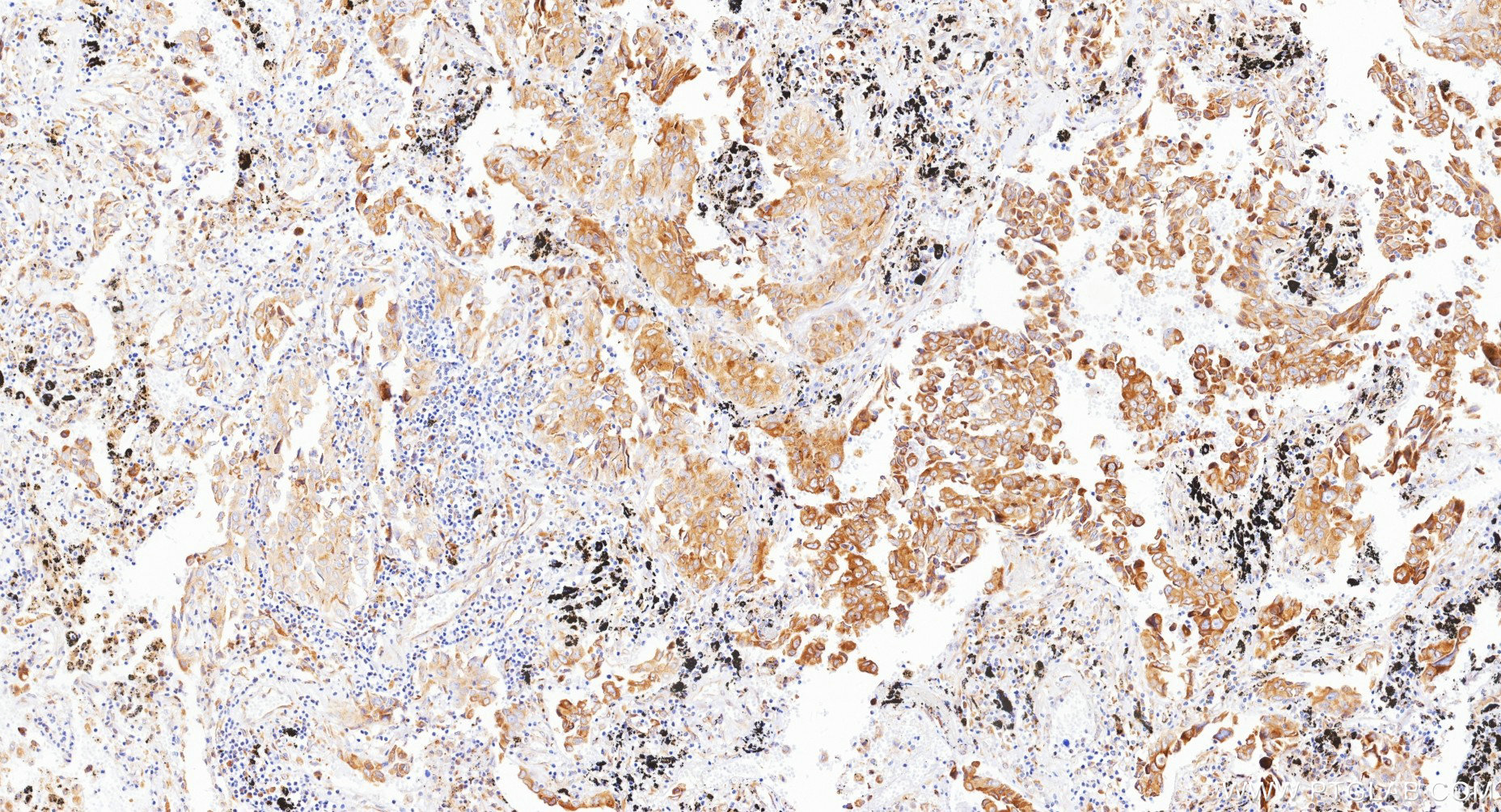 IHC staining of Human lung cancer （Adenocarcinoma） using Biotin-87837