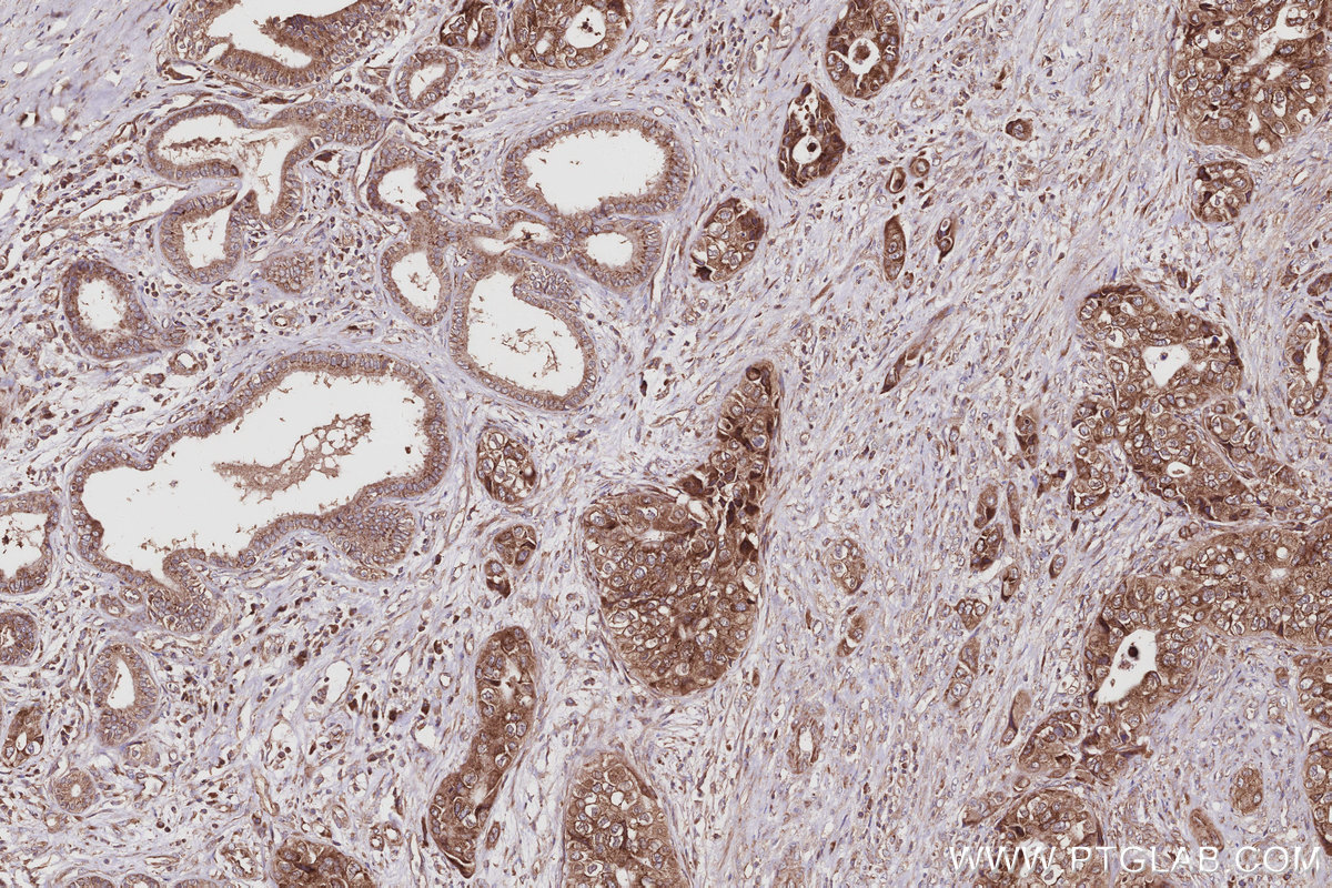 IHC staining of human pancreas cancer using 67205-1-Ig
