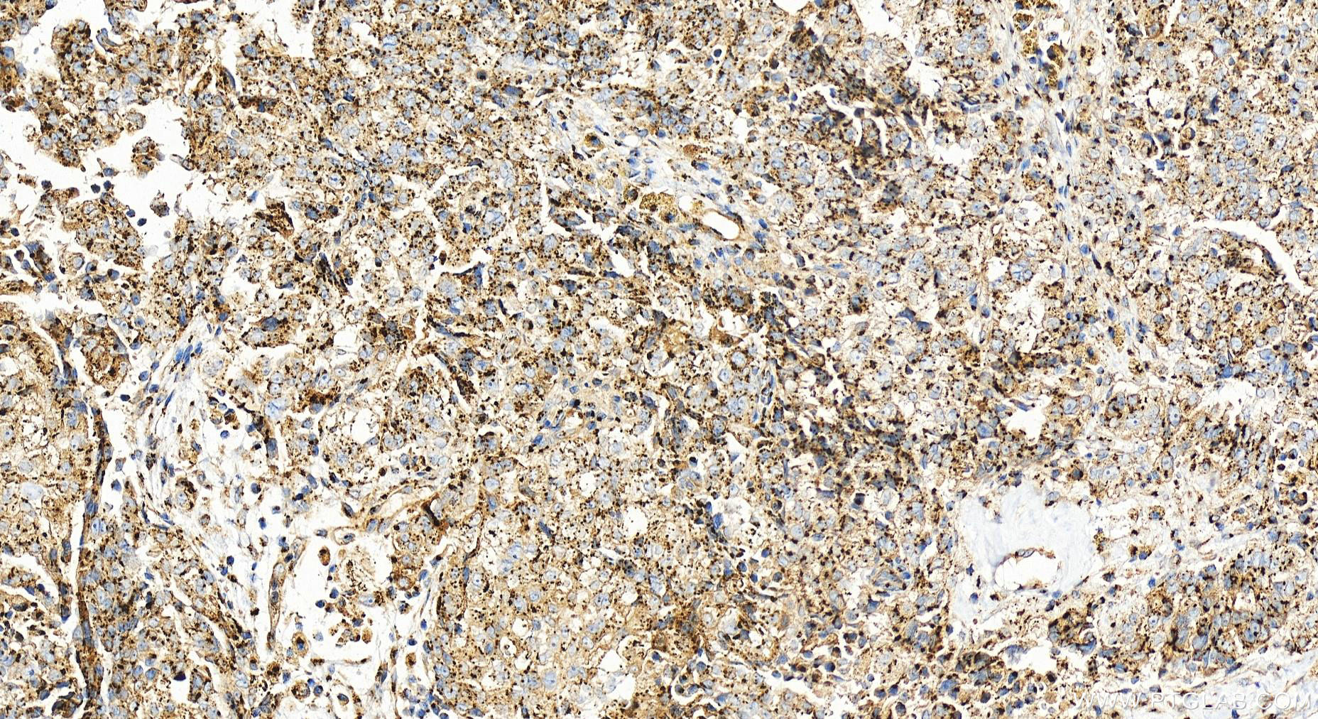 IHC staining of human ovary cancer using 25536-1-AP