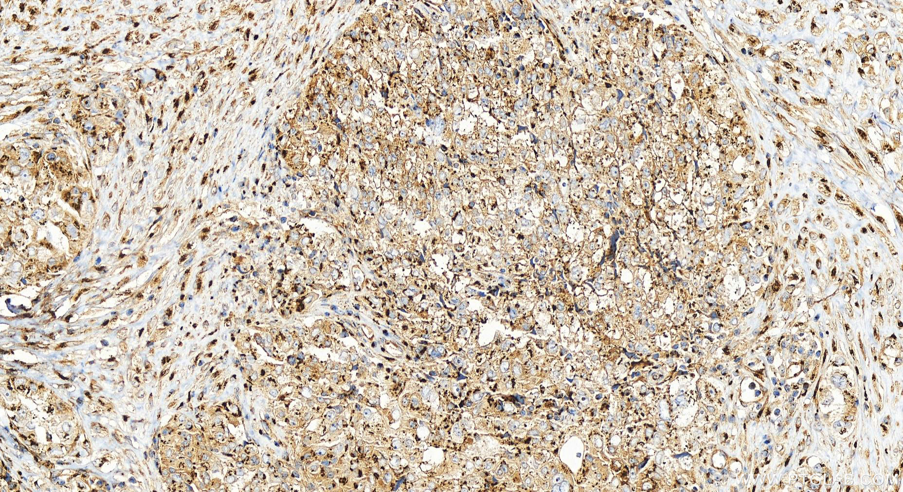 IHC staining of human ovary cancer using 25536-1-AP