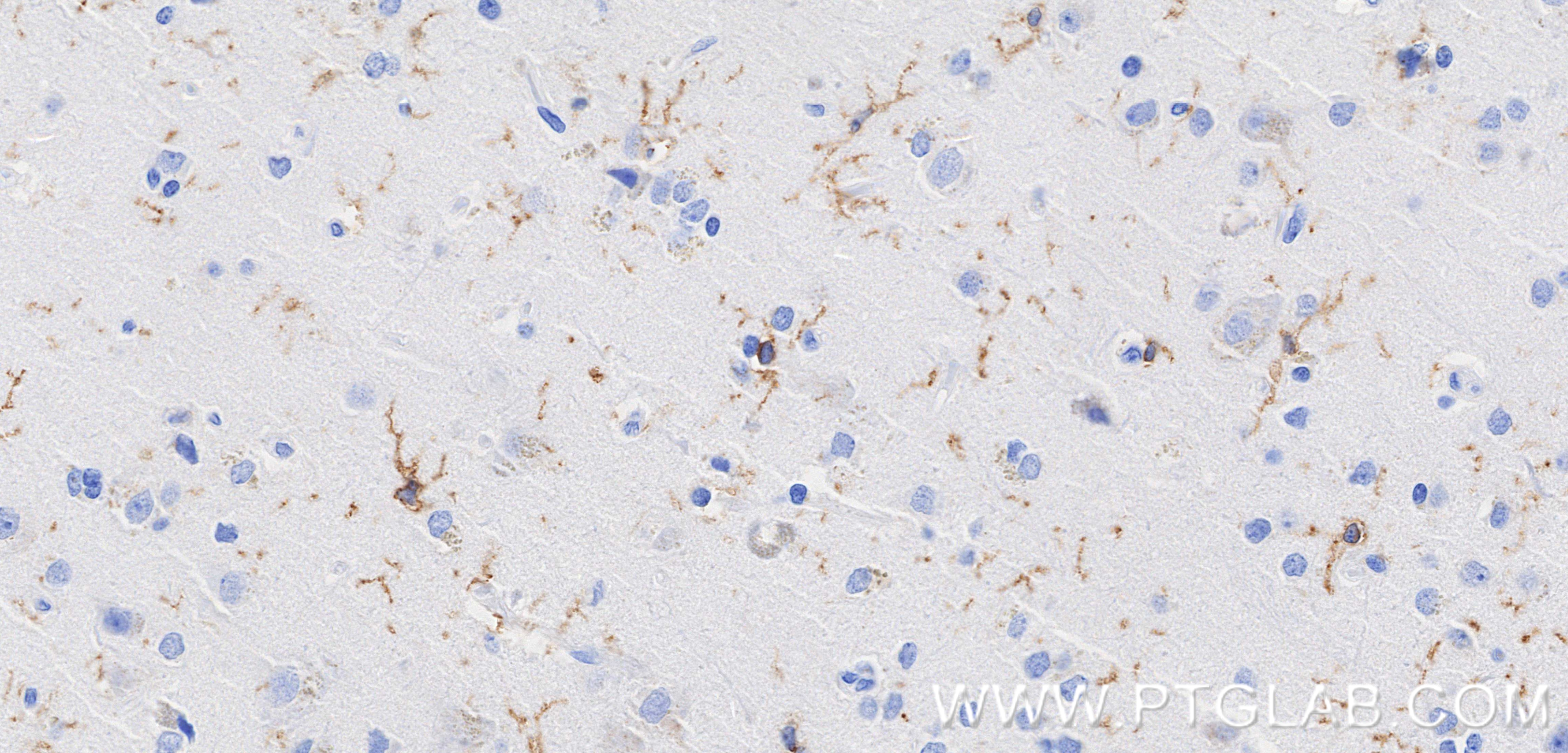 IHC staining of Human brain cancer(Astrocitoma) using 83448-9-RR IHC staining of Human brain cancer(Astrocitoma) using 83448-9-RR