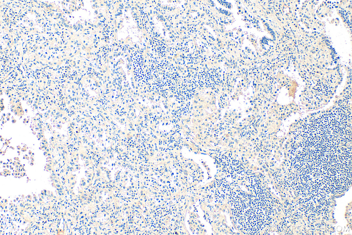 IHC staining of human lung cancer using 33212-1-AP