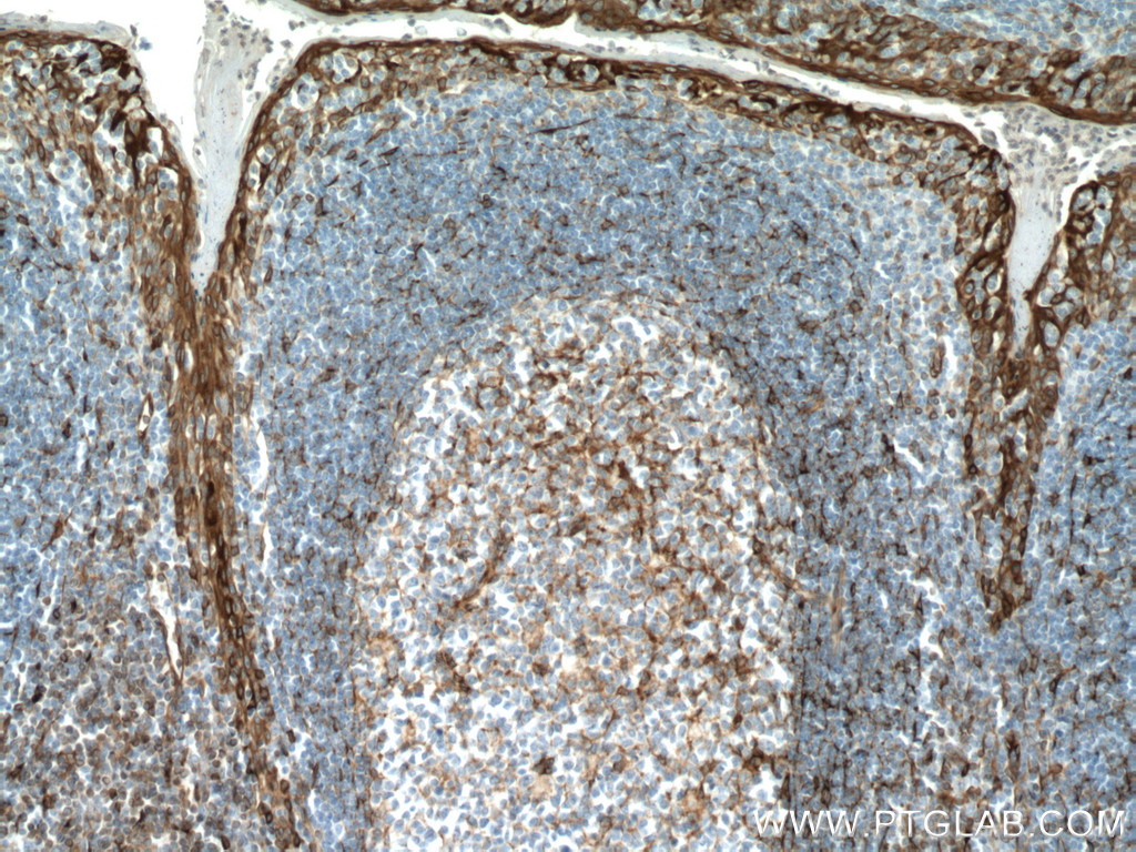 IHC staining of human tonsillitis using 66680-1-Ig