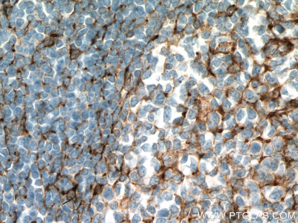 IHC staining of human tonsillitis using 66680-1-Ig