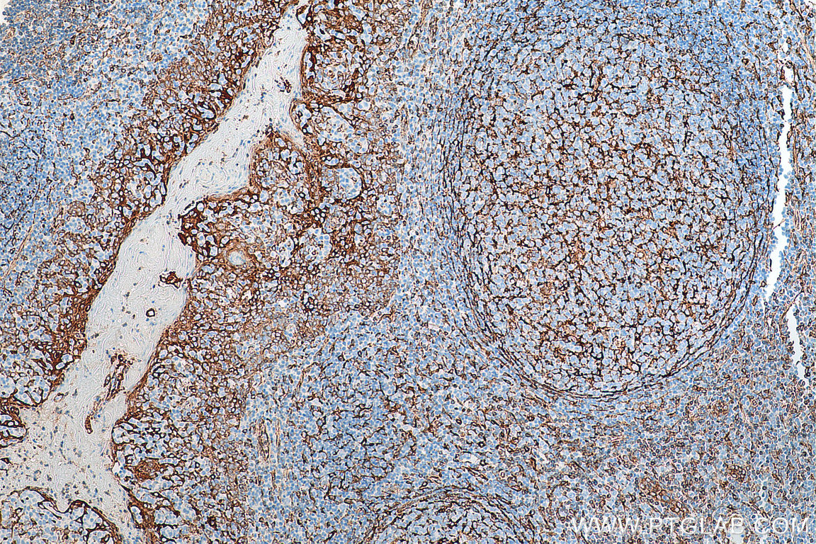 IHC staining of human tonsillitis using 80165-1-RR