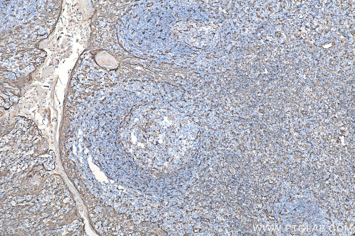 IHC staining of human tonsillitis using 80165-1-RR IHC staining of human tonsillitis using 80165-1-RR