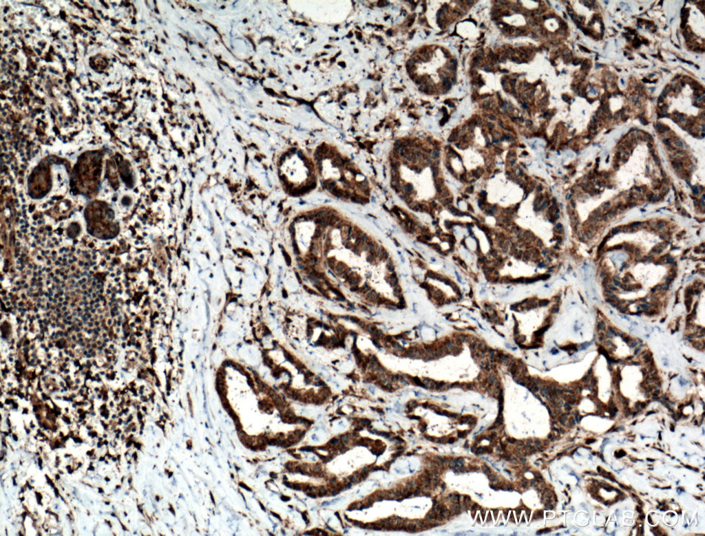 IHC staining of human breast cancer using 24799-1-AP (same clone as 24799-1-PBS)