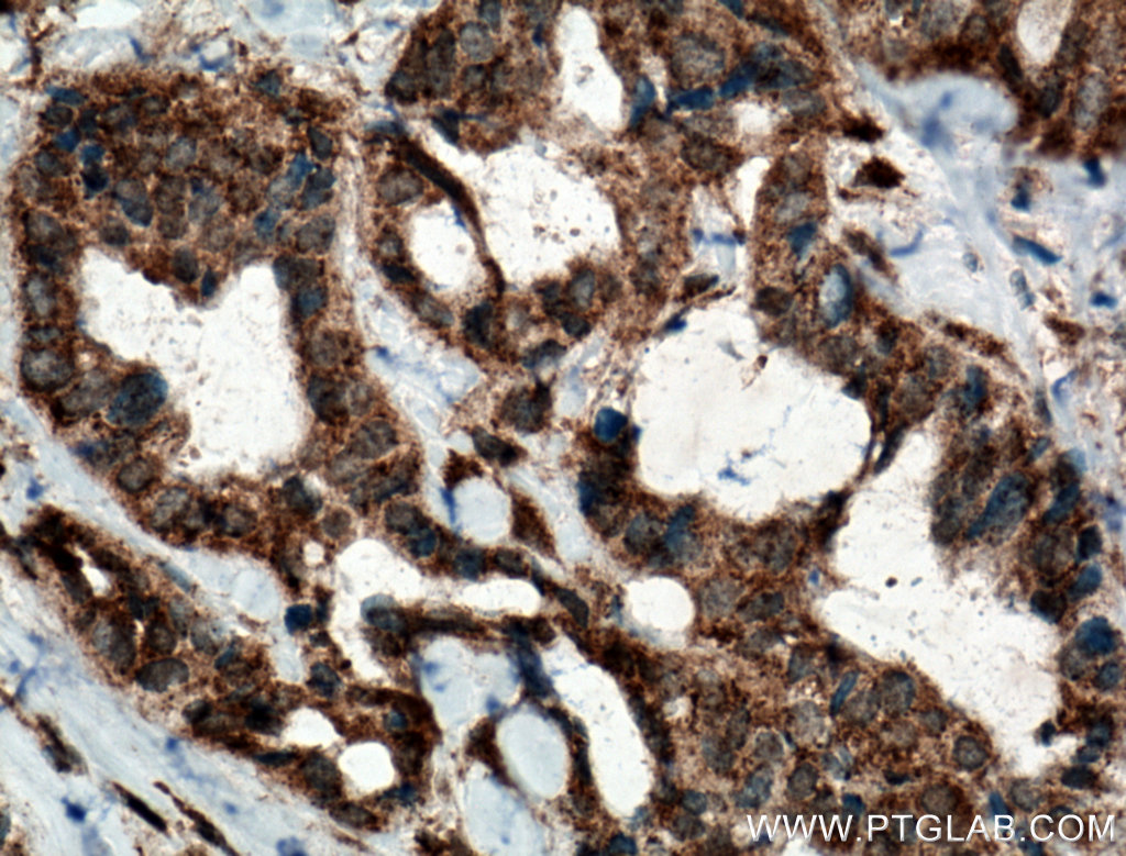 IHC staining of human breast cancer using 24799-1-AP (same clone as 24799-1-PBS)